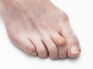 Молоткообразная деформация пальца стопы